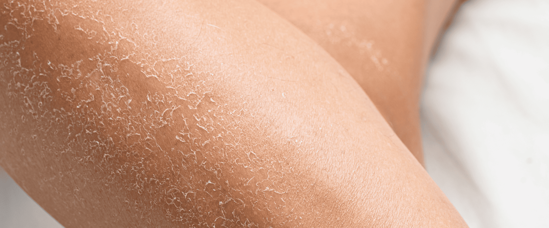 Peau sèche visage : 5 solutions naturelles efficaces (et ce qui fonctionne vraiment)